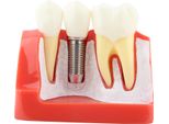 1Pc Resina Dentale Dimostrazione Dente Modello Impianto Analisi Corona Ponte Per Dentista