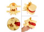1:1.5 Modello Di Dimostrazione Dell'ernia Discale Lombare Della Colonna Vertebrale Umana Anatomica Per Lo Studio Impara
