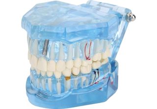 Modello Dentale Denti Mascellari Impianti Dentali