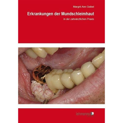 Erkrankungen der Mundschleimhaut - Margrit-Ann Geibel, Kartoniert (TB)
