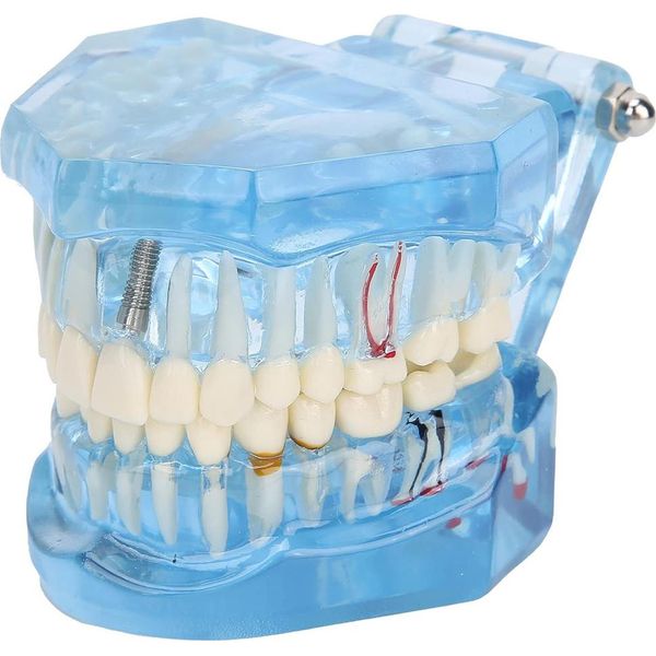 Modello Dentale Denti Mascellari Impianti Dentali-image